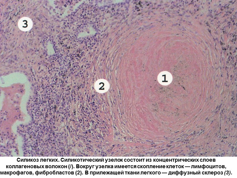 Силикоз легких. Силикотический узелок состоит из концентрических слоев коллагеновых волокон (/). Вокруг узелка имеется